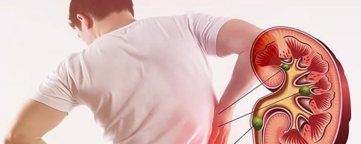 Stages of Chronic Kidney Disease