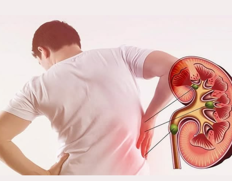 Stages of Chronic Kidney Disease