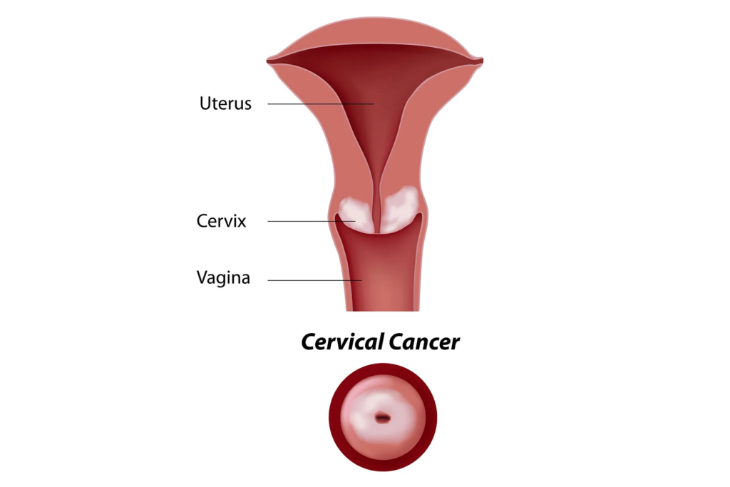 Understanding Abnormal Pap Smear Results